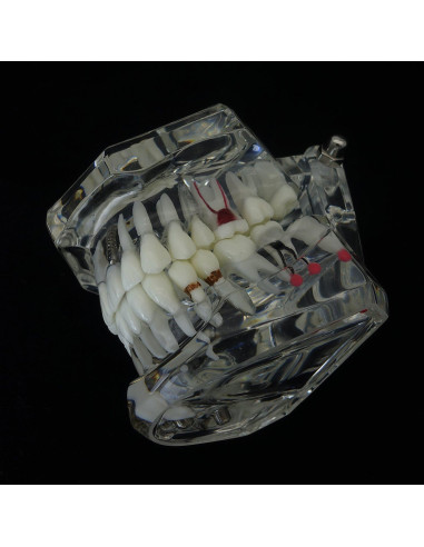 Modelo Dientes Enfermedad Dental Smile1000 con Puente