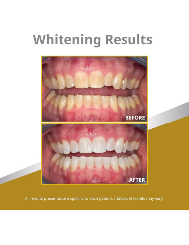 Opalescence Quick PF 45% - Blanqueamiento Dental en Jeringas - 12 Jeringas Menta