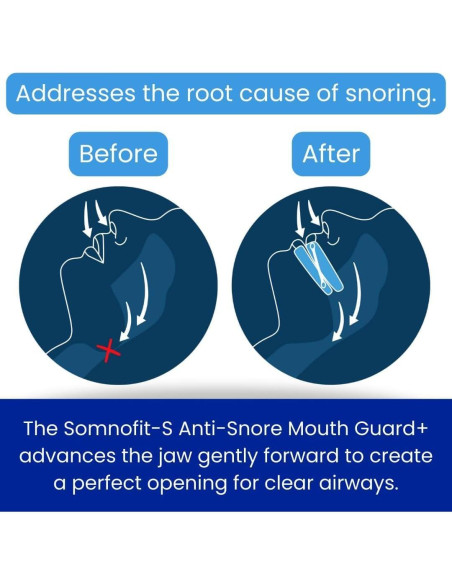 Protector Bucal Antisnoring Somnofit-S SnoreLessNow FDA Protector Bucal Antisnoring Somnofit-S SnoreLessNow FDA