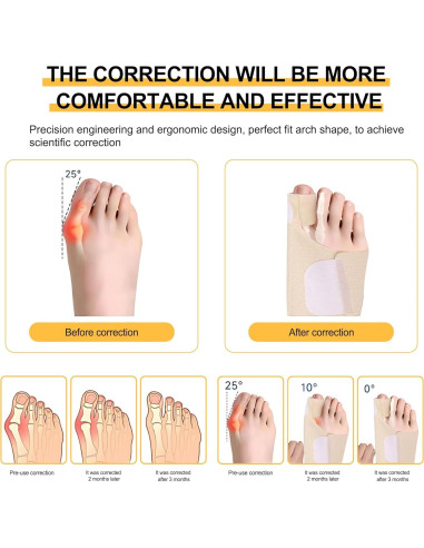 Corrector de Juanetes Siwujia para Hallux Valgus - 2 Piezas
