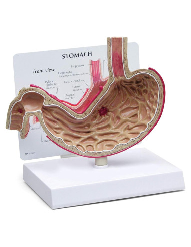 Modelo de Estómago GPI Anatomicals con Úlceras 19.05 cm