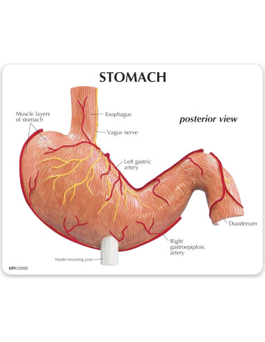 Modelo de Estómago GPI Anatomicals con Úlceras 19.05 cm