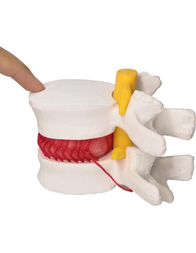 Modelo Anatómico de Disco Herniado Humano EVOTECH 13x12cm