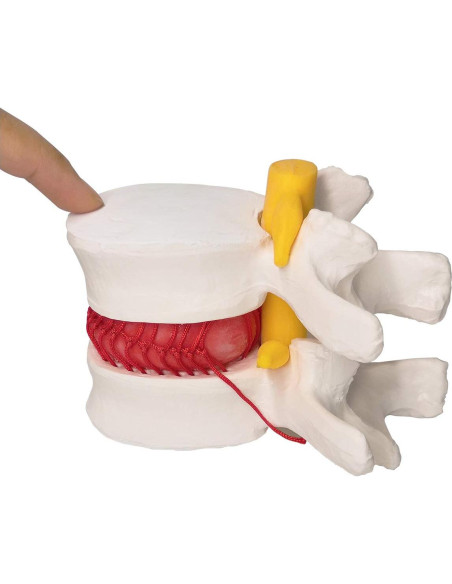 Modelo Anatómico de Disco Herniado Humano EVOTECH 13x12cm Modelo Anatómico de Disco Herniado Humano EVOTECH 13x12cm