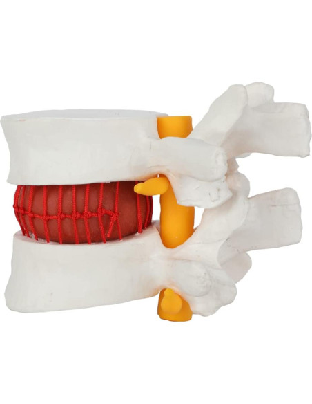 Modelo de Anatomía de Disco Herniado Lumbar Axis Scientific Modelo de Anatomía de Disco Herniado Lumbar Axis Scientific