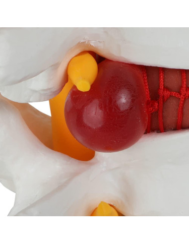 Modelo de Anatomía de Disco Herniado Lumbar Axis Scientific
