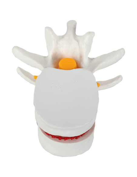 Modelo de Anatomía de Disco Herniado Lumbar Axis Scientific Modelo de Anatomía de Disco Herniado Lumbar Axis Scientific