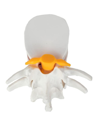 Modelo de Anatomía de Disco Herniado Lumbar Axis Scientific
