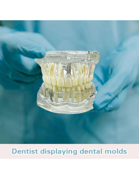Modelo Dental Transparente Windplusya con Puente e Implantes Modelo Dental Transparente Windplusya con Puente e Implantes