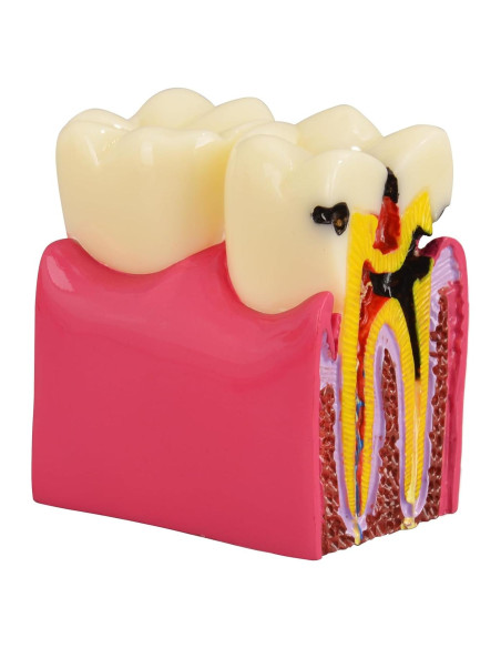 Modelo de Caries Dental Ultrassist 6 Veces Educativo 11.3x8.5cm Modelo de Caries Dental Ultrassist 6 Veces Educativo 11.3x8.5cm