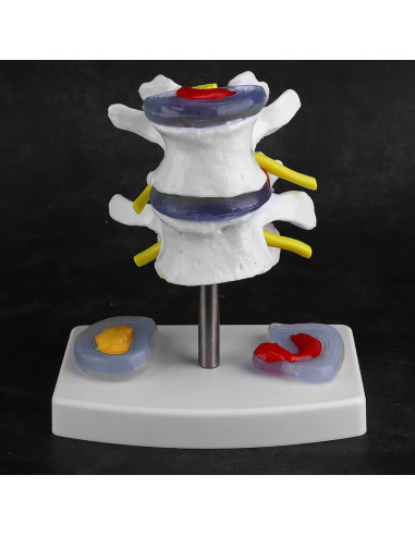Modelo de Columna Vertebral YUYTE - Herniación Disco Lumbar PVC