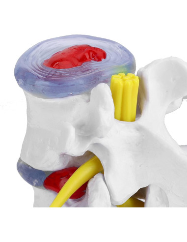 Modelo de Columna Vertebral YUYTE - Herniación Disco Lumbar PVC
