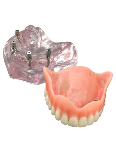Modelo Dental Sobredentadura Superior Smile1000 4 Implantes