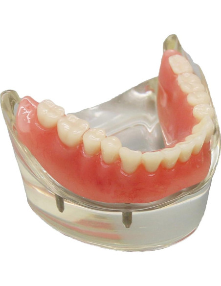 Modelo Dental Sobredentadura Inferior Smile1000 4 Implantes Modelo Dental Sobredentadura Inferior Smile1000 4 Implantes
