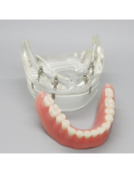 Modelo Dental Sobredentadura Inferior Smile1000 4 Implantes Modelo Dental Sobredentadura Inferior Smile1000 4 Implantes