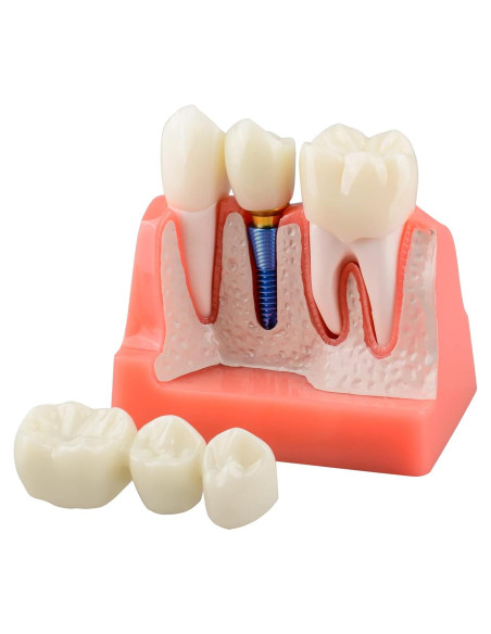 Modelo de Implante Dental Ultrassist 4X con Corona y Puente Modelo de Implante Dental Ultrassist 4X con Corona y Puente