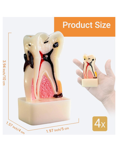Modelo Dental 3D MediTrainer con Caries y Enfermedad Periodontal