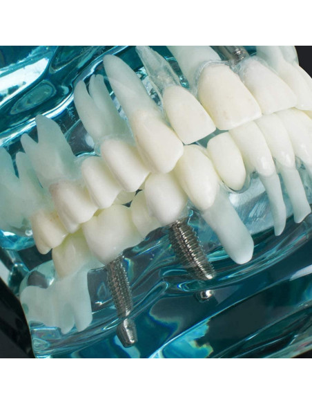 Modelo de Implante Dental Typodont Azul Transparente Modelo de Implante Dental Typodont Azul Transparente