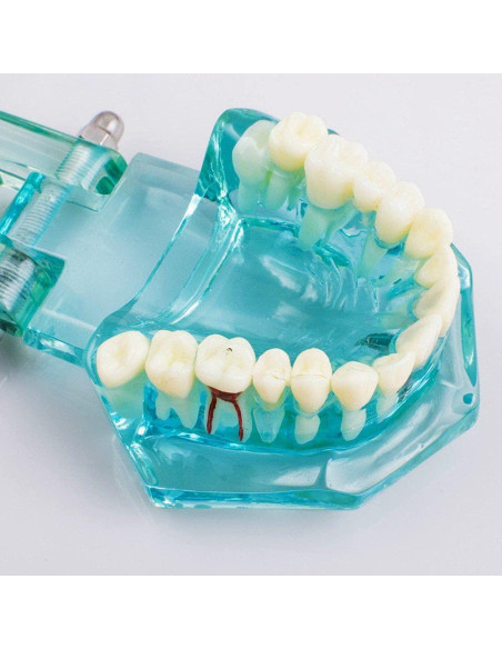 Modelo de Implante Dental Typodont Azul Transparente Modelo de Implante Dental Typodont Azul Transparente