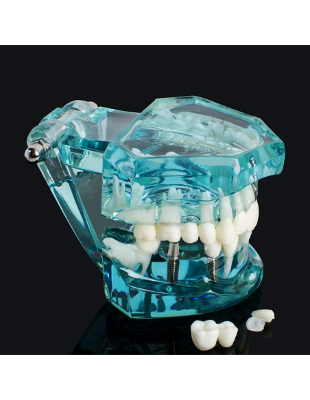 Modelo de Implante Dental Typodont Azul Transparente Modelo de Implante Dental Typodont Azul Transparente