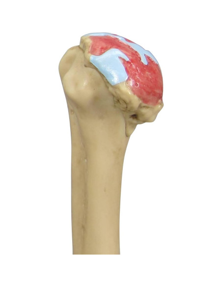 Modelo Anatómico de Hombro Osteoartrítico GPI 4 Etapas Modelo Anatómico de Hombro Osteoartrítico GPI 4 Etapas