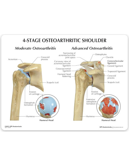 Modelo Anatómico de Hombro Osteoartrítico GPI 4 Etapas Modelo Anatómico de Hombro Osteoartrítico GPI 4 Etapas