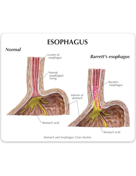 Modelo Estómago GERD GPI ANATOMICALS 10cm para Educación Médica Modelo Estómago GERD GPI ANATOMICALS 10cm para Educación Médica