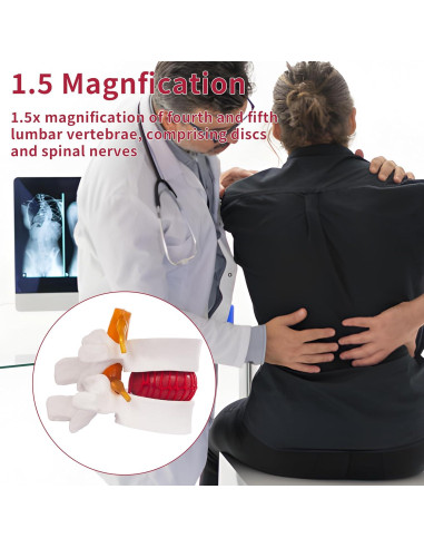 Modelo Anatómico de Herniación del Disco Lumbar Ruiishunyy