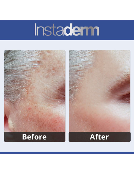 Crema Correctora de Manchas Oscuras Instaderm 51.2 ml Crema Correctora de Manchas Oscuras Instaderm 51.2 ml