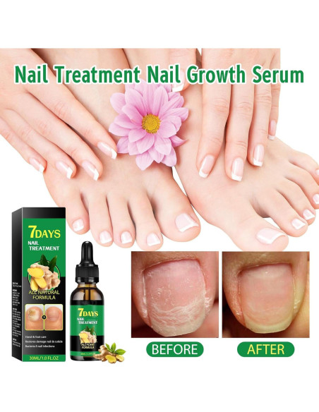 Aceite de Uñas de Jengibre 2PCS - Fortalece y Promueve Crecimiento Aceite de Uñas de Jengibre 2PCS - Fortalece y Promueve Crecimiento