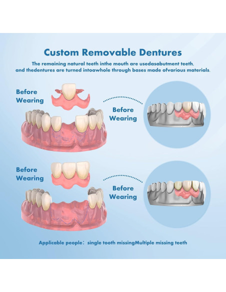 Dentaduras Removibles Personalizadas Qiivosm - 2 Dientes Dentaduras Removibles Personalizadas Qiivosm - 2 Dientes