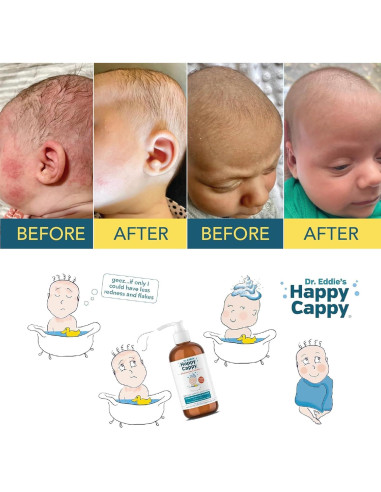 Champú y gel de baño medicado Happy Cappy 236.6 ml para bebés