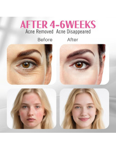 Máscara Facial LED Auxoliev FSA Pro - Terapia de Luz para Acné y Arrugas 2