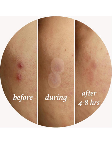 Parche Hidrocoloide Julep Me Up para Acné - 72 Piezas