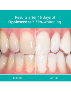 Kit Blanqueamiento Dental Opalescence 35% PF - 4 Jeringas 2