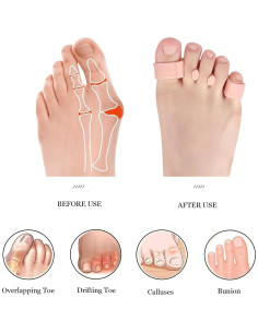 Separadores de Dedos Qidie 4 Pcs Alivio Fascitis Plantar 2