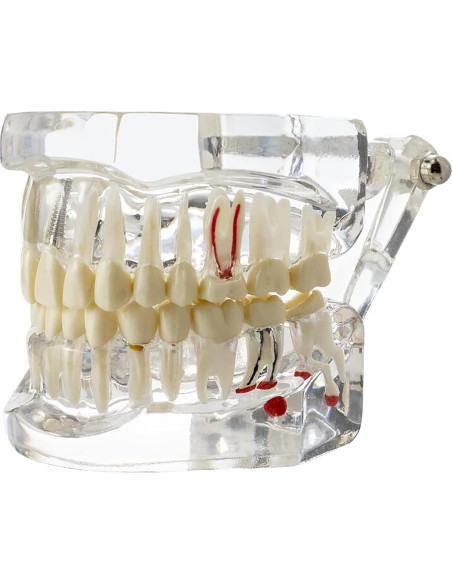 Modelo Dental Typodont Implantológico Dentalmall 2001C Modelo Dental Typodont Implantológico Dentalmall 2001C