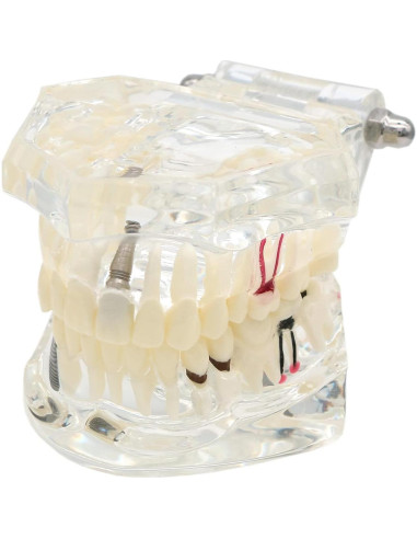 Modelo Dental Typodont Implantológico Dentalmall 2001C