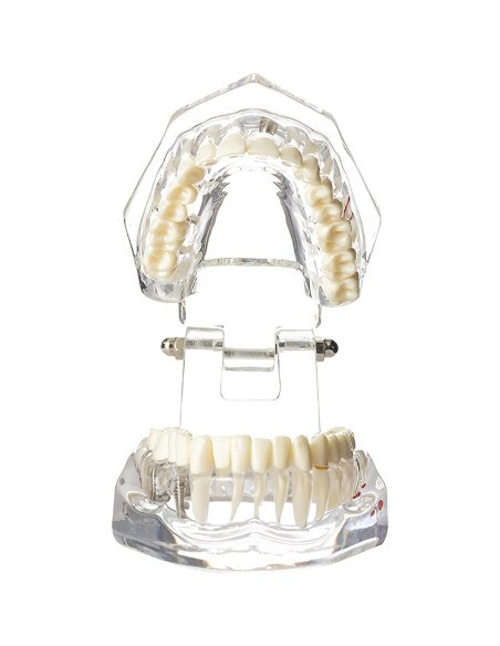 Modelo Dental Typodont Implantológico Dentalmall 2001C Modelo Dental Typodont Implantológico Dentalmall 2001C