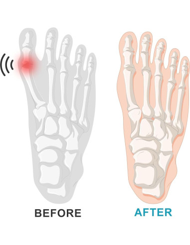 Manga Correctora de Juanetes Qxotvzy - 2 Pares Gel Transpirable