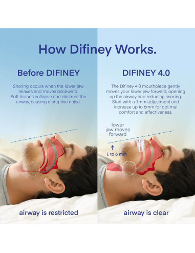 Dispositivo Antisnoring Difiney 4.0 Protector Bucal Ajustable