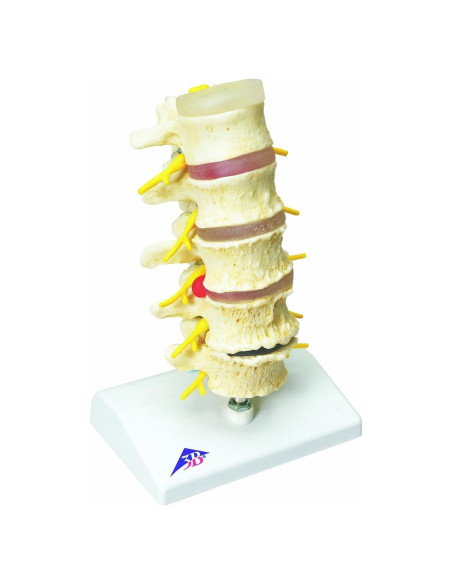 Modelo Anatómico 3B Scientific de Degeneración Vertebral 23 cm Modelo Anatómico 3B Scientific de Degeneración Vertebral 23 cm