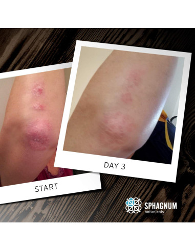 Jabón Corporal Natural Sphagnum 399.5 ml para Psoriasis y Eczema