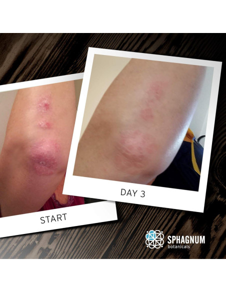 Jabón Corporal Natural Sphagnum 399.5 ml para Psoriasis y Eczema