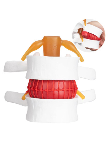 Modelo Anatómico de Hernia de Disco Lumbar Healthible - PVC 1.5X