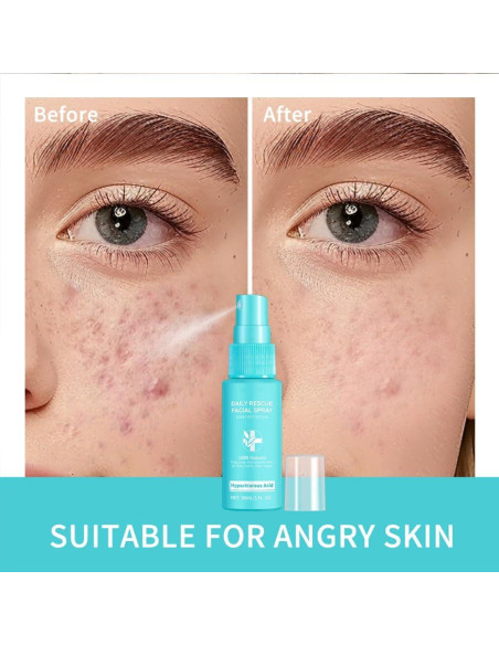 Spray Facial de Rescate Diario Loske - Ácido Hipocloroso 100g Spray Facial de Rescate Diario Loske - Ácido Hipocloroso 100g
