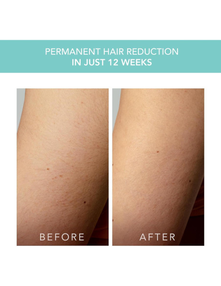 Dispositivo IPL FOREO PEACH 2 go - Eliminación Vello Sin Dolor Dispositivo IPL FOREO PEACH 2 go - Eliminación Vello Sin Dolor