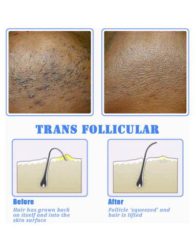Cepillo Exfoliante TailaiMei para Vello Encarnado y Bultos