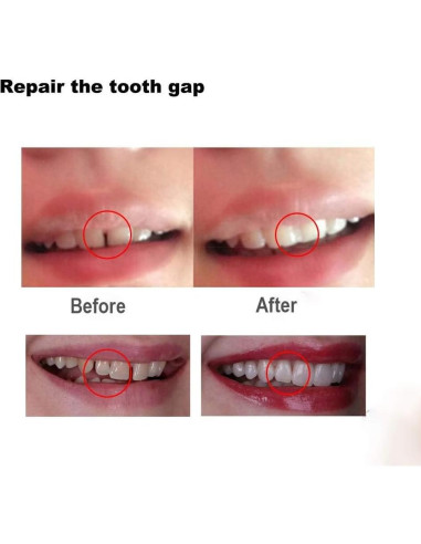 Perlas Térmicas Brige para Relleno Dental - 1000 Perlas