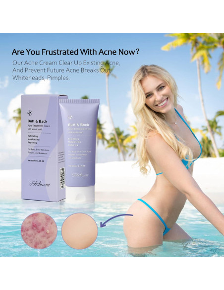 Crema Corporal Antiacné Loción Loción 130g para Espalda y Glúteos Crema Corporal Antiacné Loción Loción 130g para Espalda y Glúteos